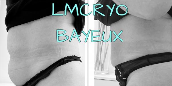 Cryothérapie - LM CRYO à Bayeux 